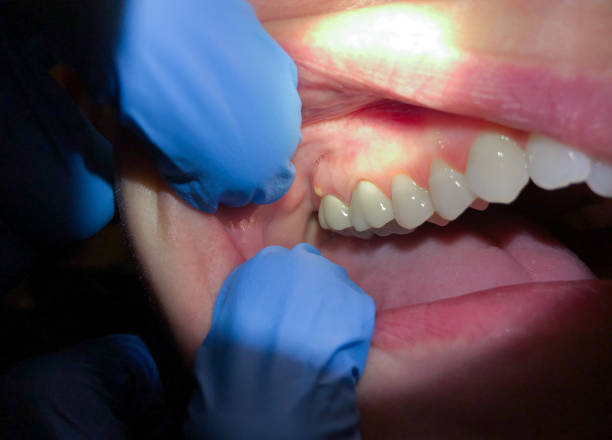 Best Root Canal Emergency Dentist  in Livingston, TN